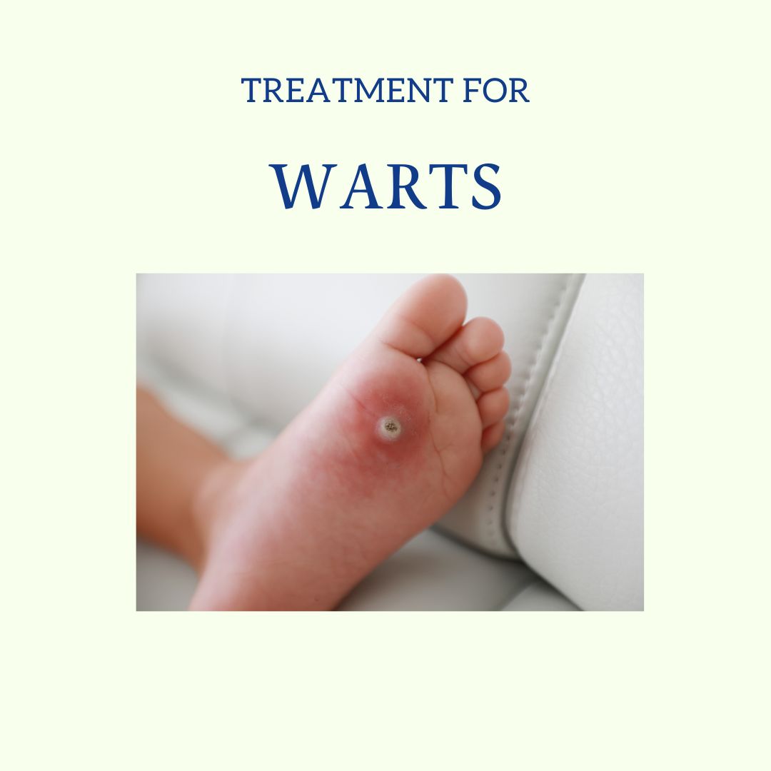 Warts