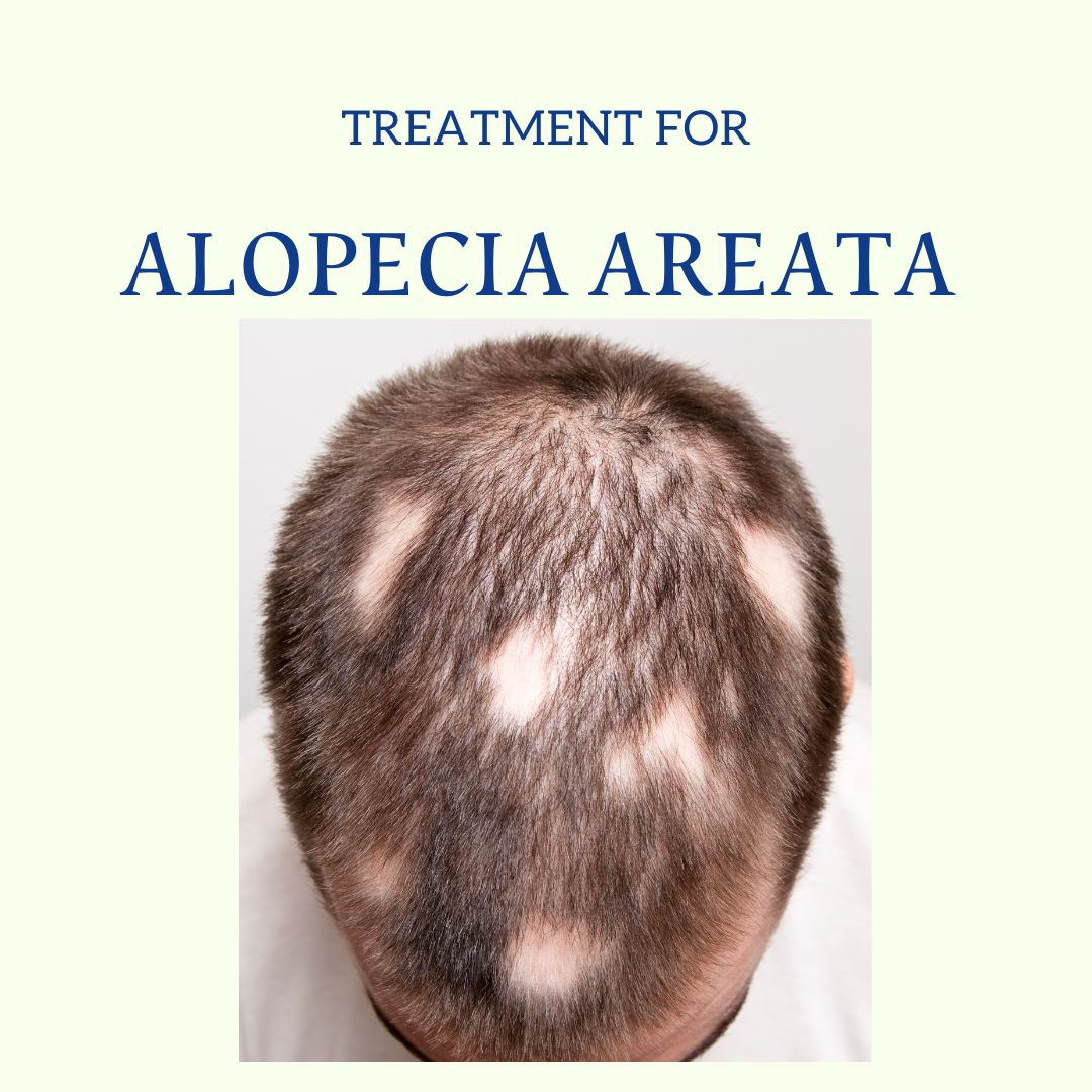 Alopecia Areata